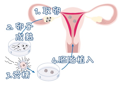 关于私人同性供卵代怀服务怎么选
